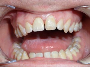Имплантация переднего зуба