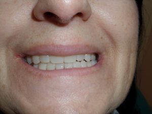 Двучелюстное протезирование зубов с опорой на импланты