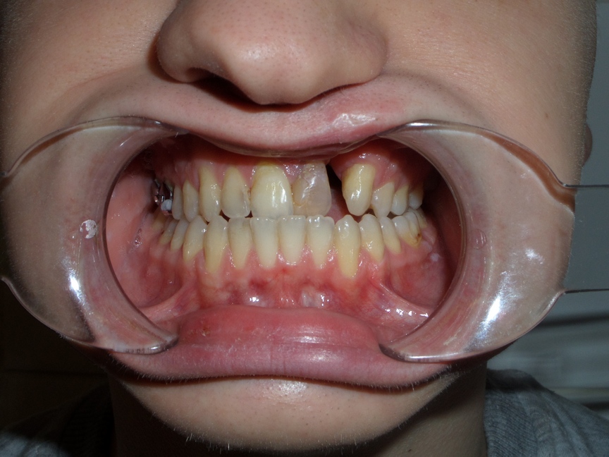 Протезирование у пациентов с расщелиной верхней губы