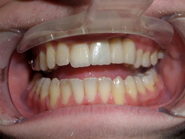 Протезирование у пациентов с расщелиной верхней губы